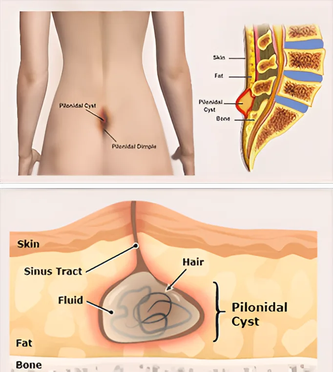 PILONIDAL SURGERY